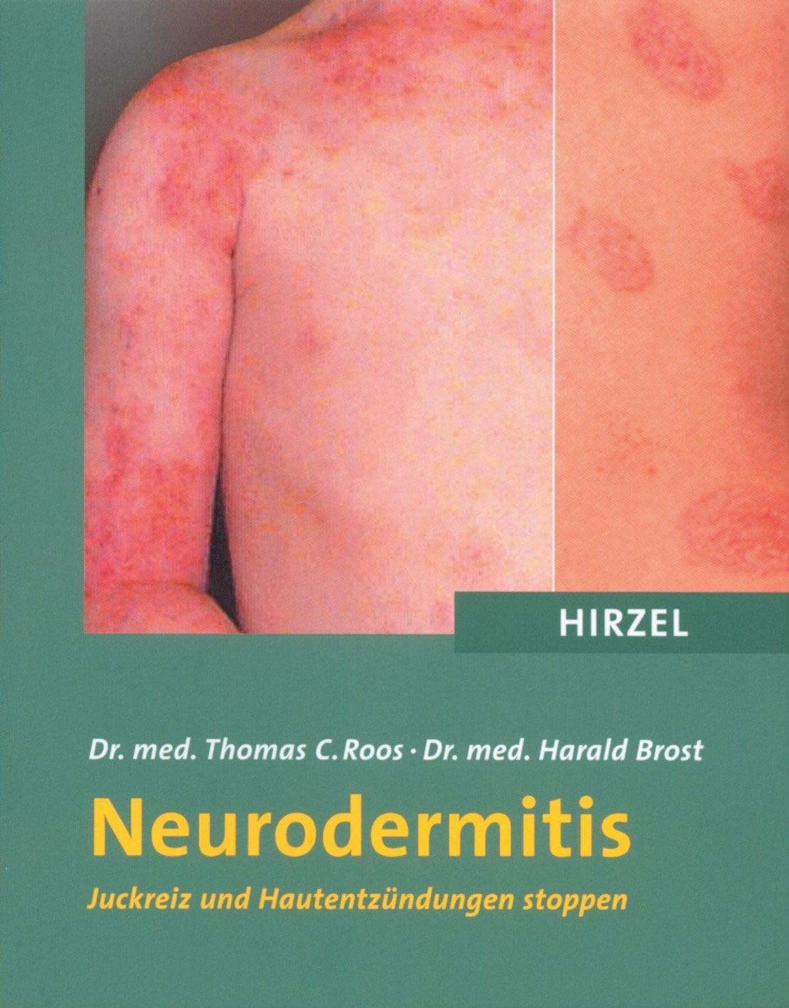 Portada de Neurodermitis: Juckreiz und Hautentzündungen stoppen
